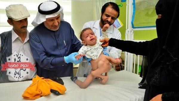 نجاح عملية فصل توأم طفيلي لطفل يمني بالسعودية