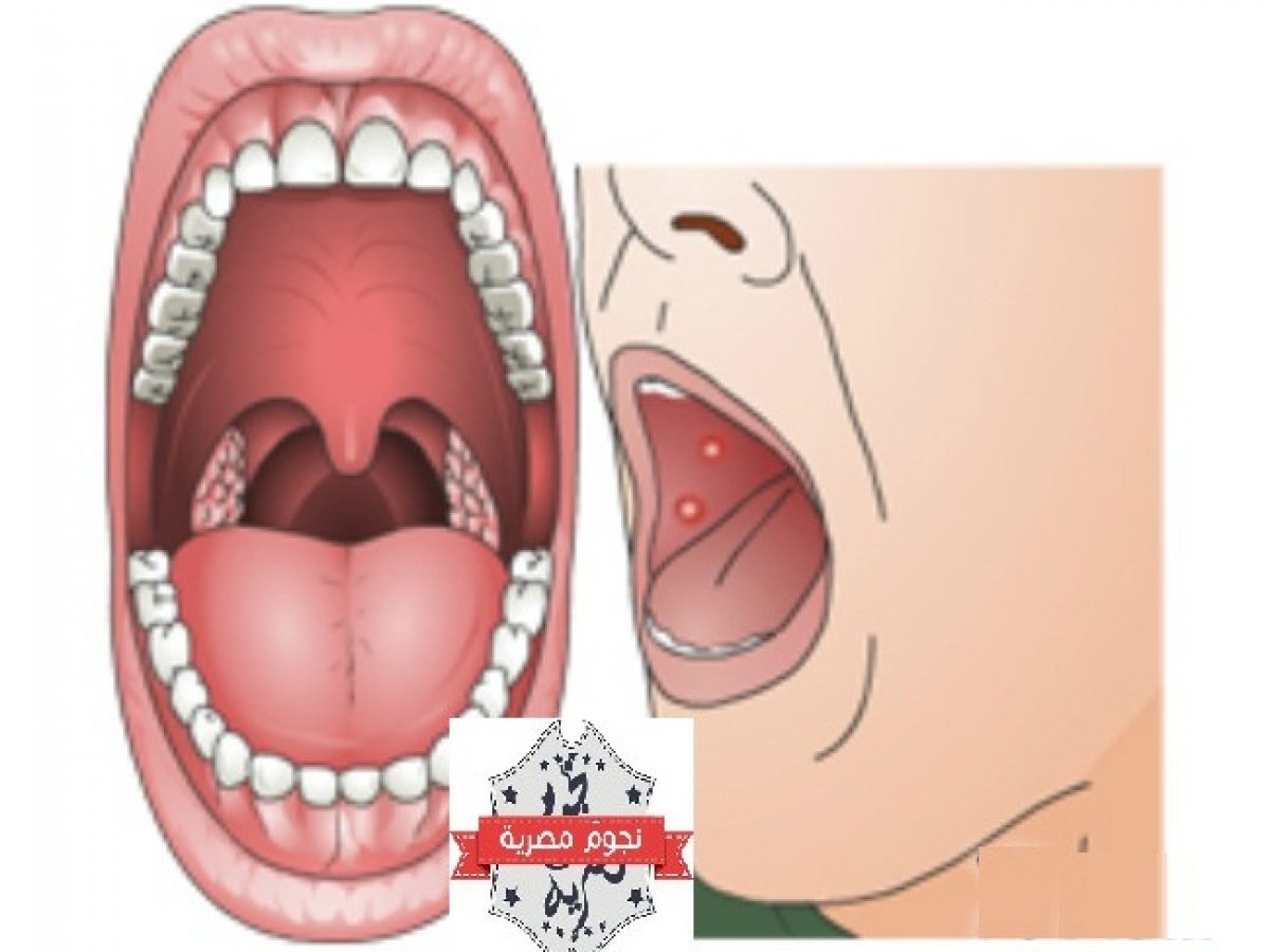 7 علامات تظهر في الفم تدل على إصابتك بأمراض خطيرة منها السرطان