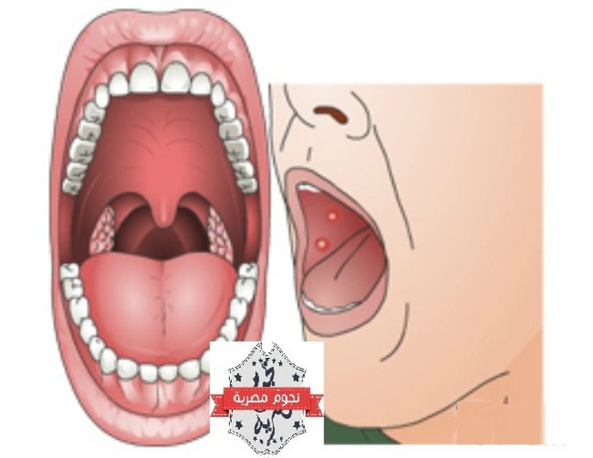 7 علامات تظهر في الفم تدل على إصابتك بأمراض خطيرة منها السرطان