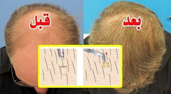 اسعار زراعة الشعر في السعودية