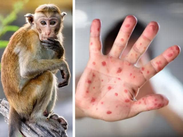 طرق انتشار فيروس جدري القرود