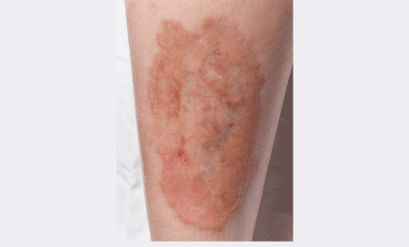 علامات على الجلد تشير إلى الإصابة بالسكري