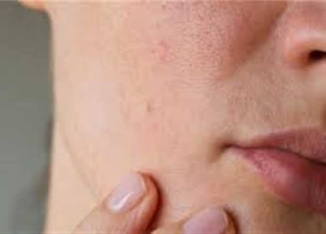 علامات على الجلد تشير إلى الإصابة بالسكري
