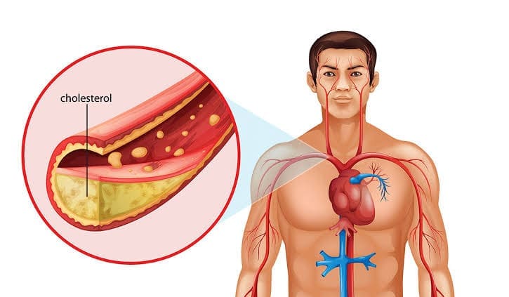 سلسلة الأمراض الباطنة... أسباب وأعراض ارتفاع الكوليسترول في الدم وخطره على القلب