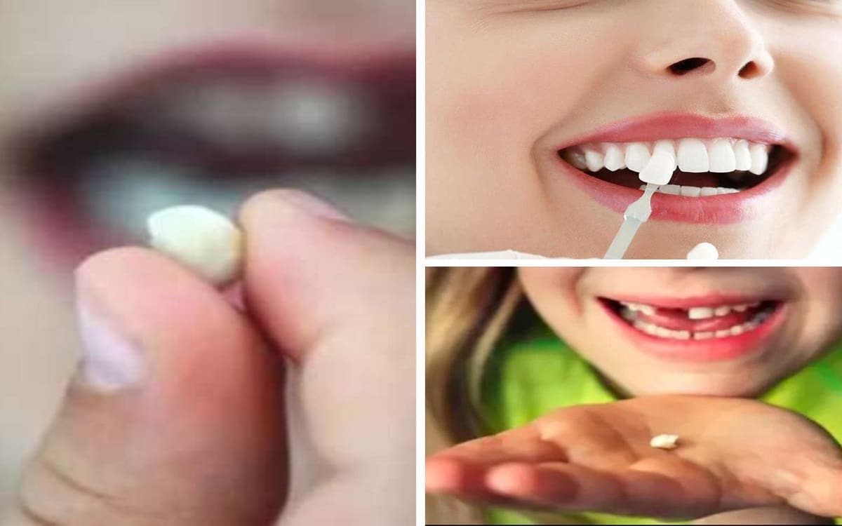تفسير حلم سقوط الأسنان